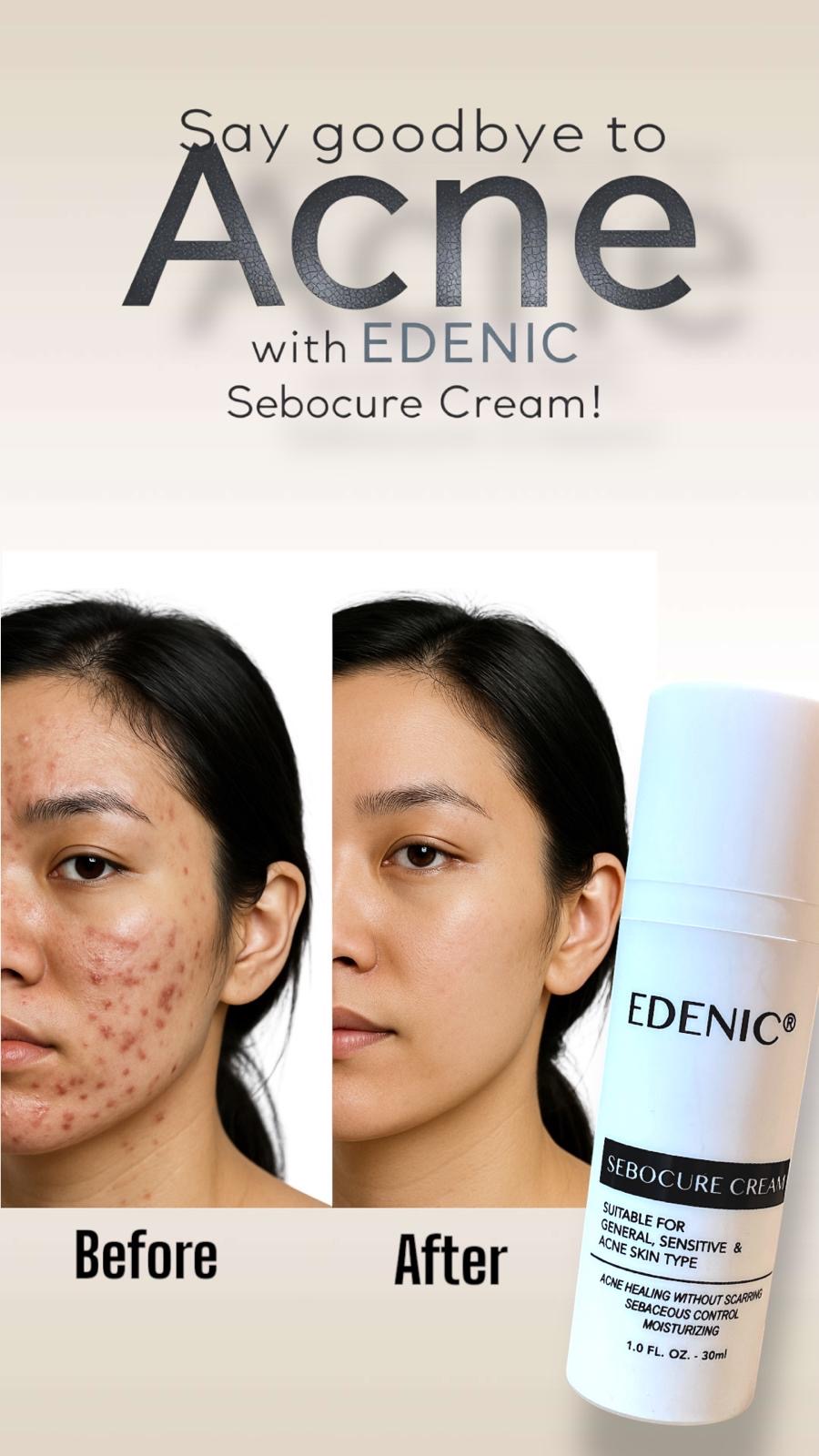EDENIC Sebocure Acne Cream 30ml for Acne-Prone Sensitive Skin